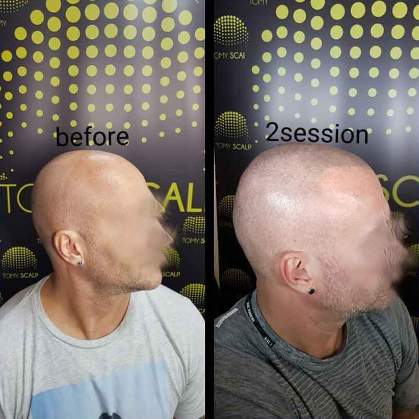 Mikropigmentacija Vlasista 1