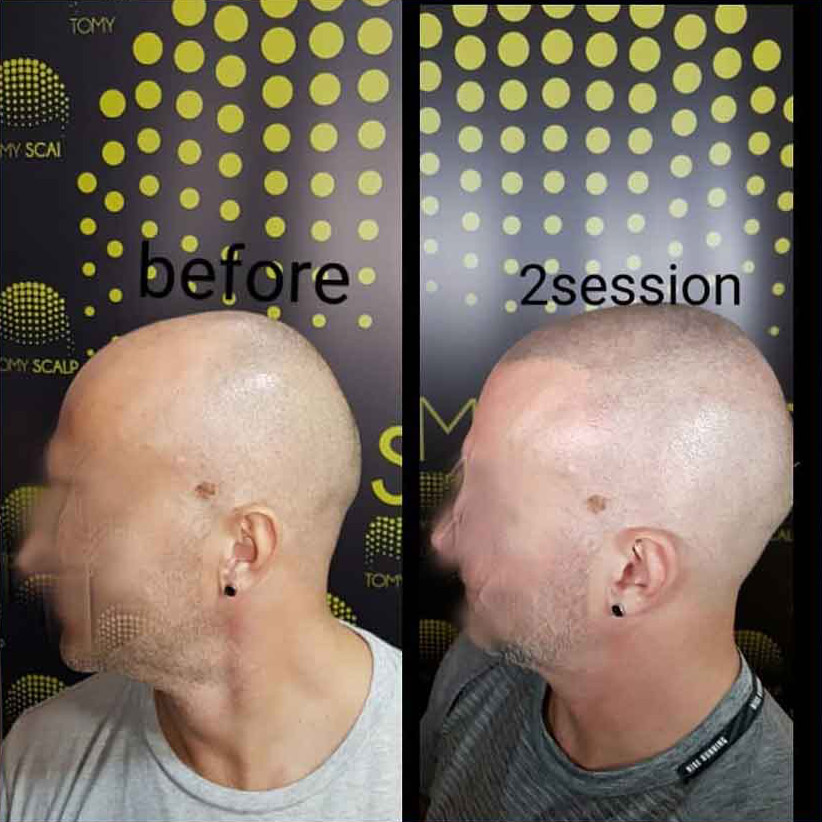 Mikropigmentacija Vlasista1 1