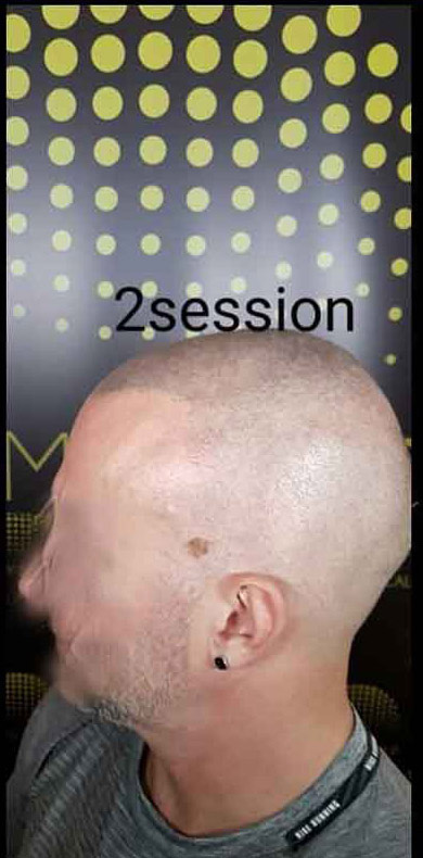 mikropigmentacija vlasista1 3a