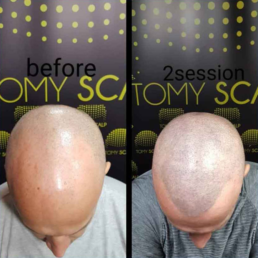 Mikropigmentacija Vlasista2 1