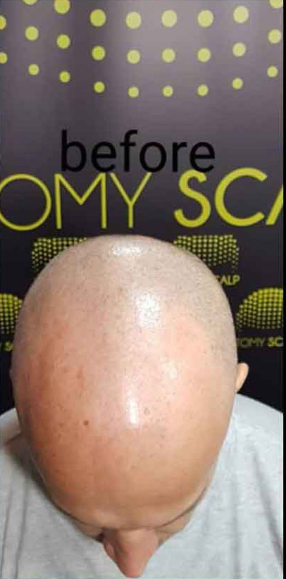 Mikropigmentacija Vlasista2 2 1