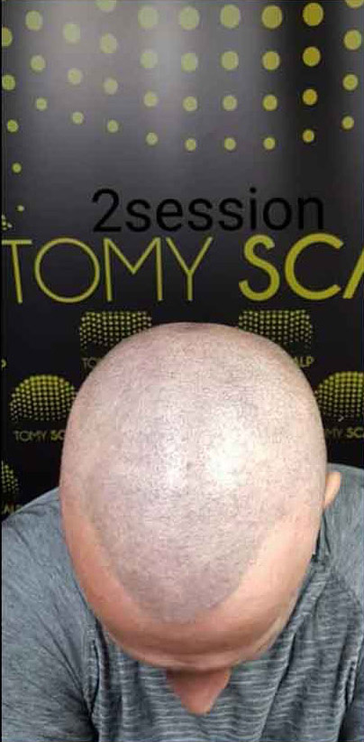 Mikropigmentacija Vlasista2 3 1