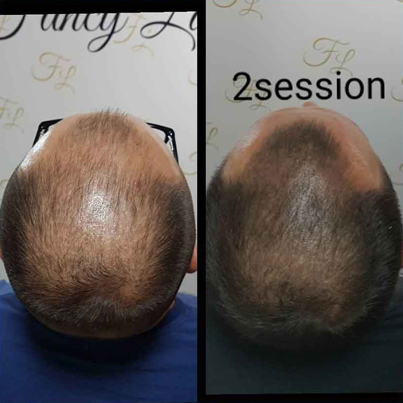 Mikropigmentacija Vlasista5 1